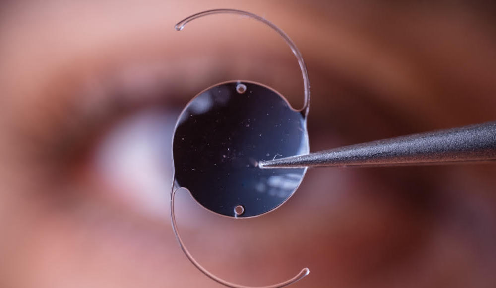 Implants Astigmatie.