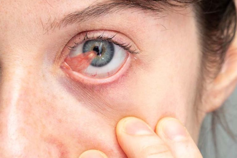 Chirurgie du Ptérygion