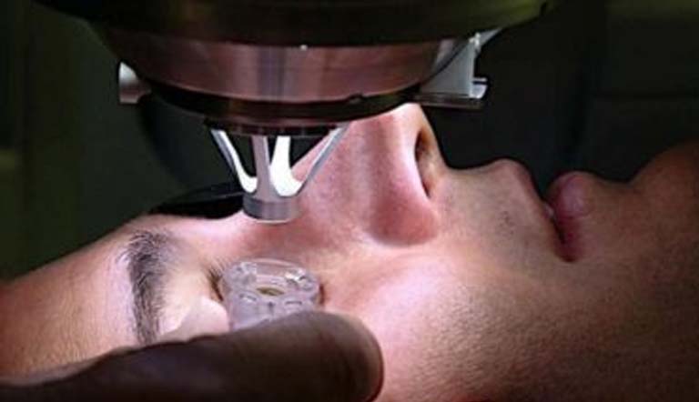 LASIK Femtoseconde