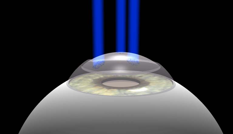 Laser Excimer — PRK / TransPRK