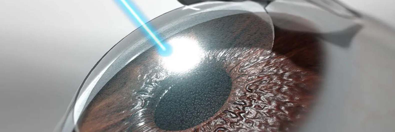 Chirurgie réfractive