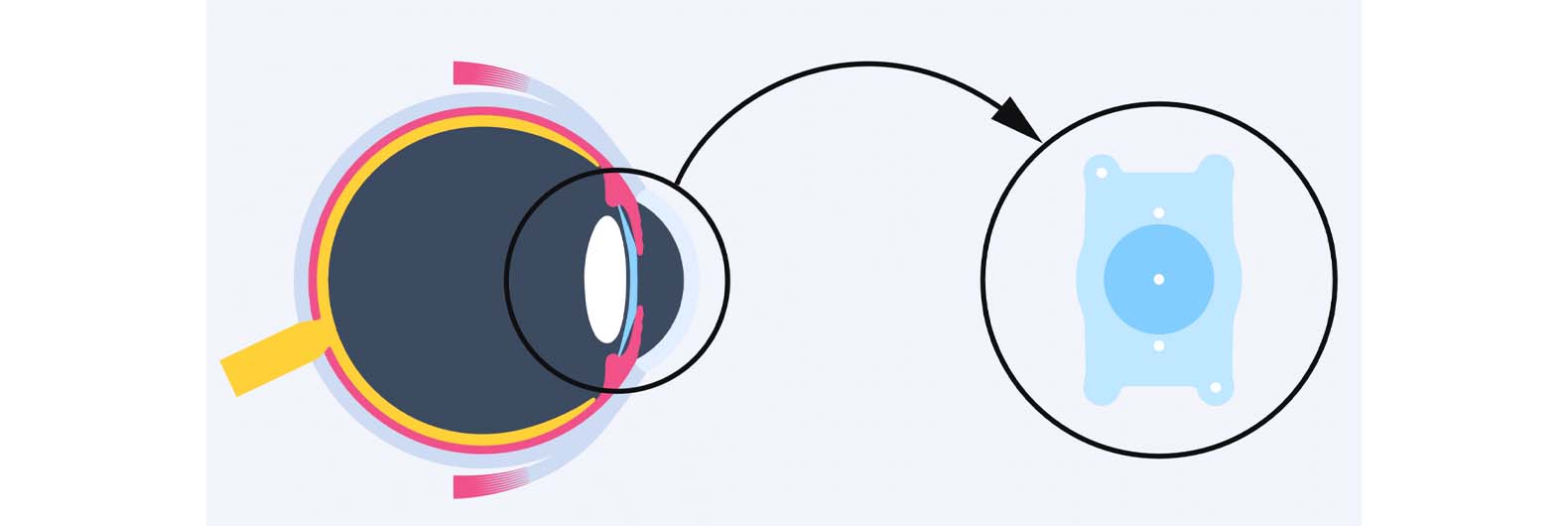 Chirurgie réfractive