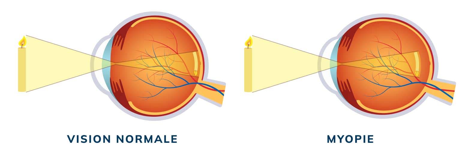 Chirurgie réfractive