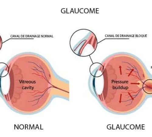 glaucome-definition-cause-quand-s-inquieter-tension-oeil-chirurgien-ophtalmologue-paupieres-paris-docteur-florence-pouget-theron-paris